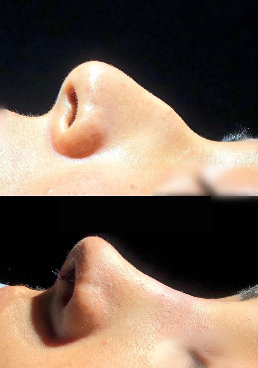 عمل بینی اقساطی